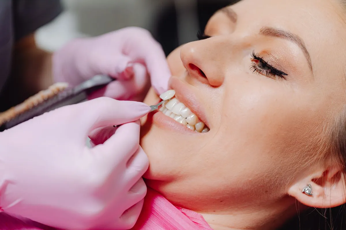 Prueba de carillas dentales